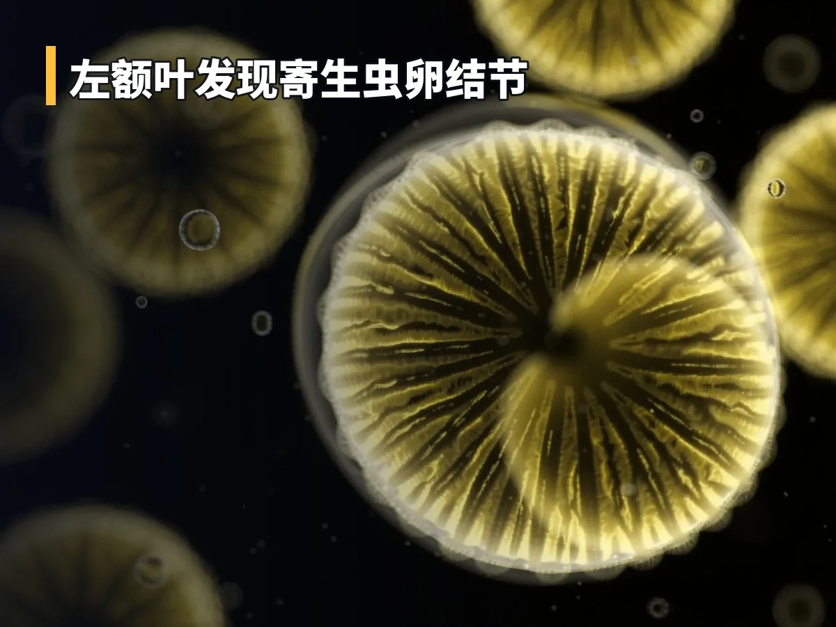 左额叶发现寄生虫卵结节